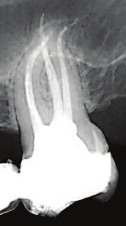 Cement (Dentsply/Maillefer) and System B (Sybron Endo) and Obtura II (Obtura Spartan).