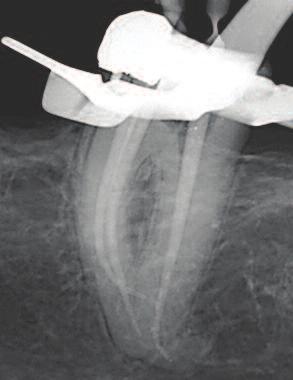 C+ Files (Dentsply/Maillefer), size 08 and 10 (Figure 16d) in conjunction with size 08 K-Files were used to negotiate the mesial root canals until the apex locator reported that apical patency was