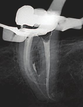 13 mm)(figure 16f) was introduced into the root canals with a delicate in and out movement until working length was reached ensuring not to keep the file rotating in a stationary position in the