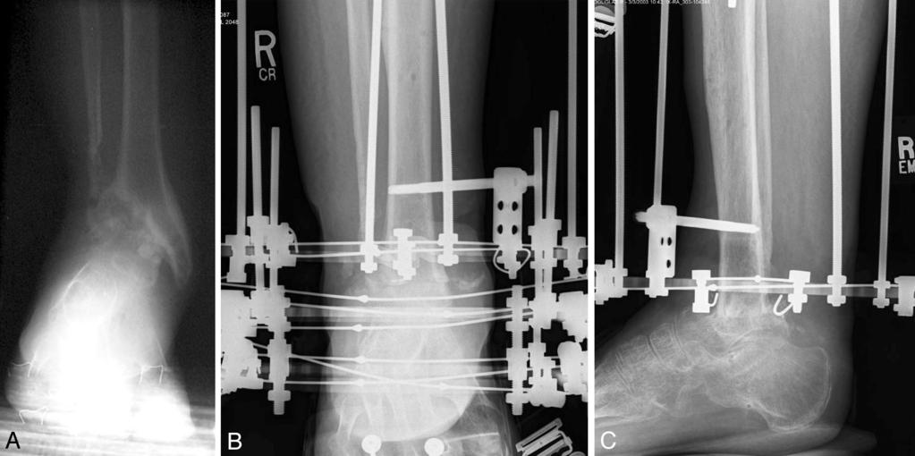 ILIZAROV EXTERNAL FIXATION AFTER FAILED INTERNAL FIXATION 499 FIG. 6. Associated infection of bone/active nondraining infections.