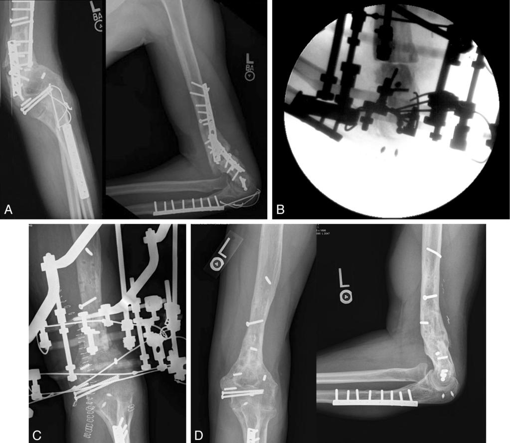 494 M.R. BRINKER AND D.P. O CONNOR FIG. 2. Failure of plate and screw fixation. (A) Presenting radiographs of a 34-year-old man following failed internal fixation for a severe distal humeral nonunion.