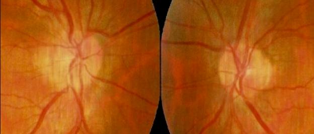 Pre to Post Flight Papilledema: A Clinical Sign of