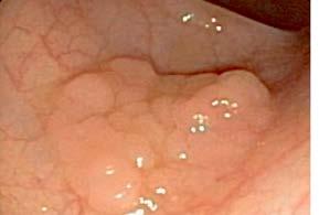 Serrated polyposis syndrome (SPS) Formerly called hyperplastic polyposis WHO criteria 5 or more serrated polyps proximal to sigmoid colon with 2 > 1cm 1 proximal serrated polyp in patient with family