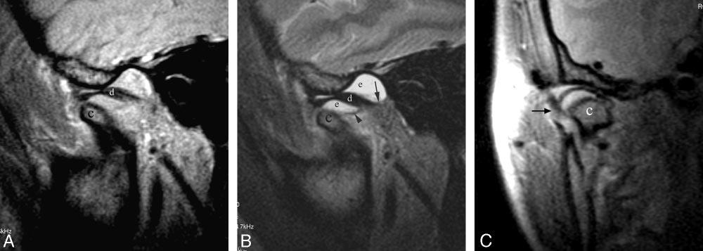 Fig 3. Patient with a dislocated mandibular condylar fracture.