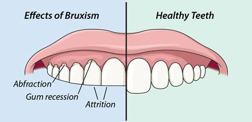 If someone has a bad bite or malocclusion, that person may be attempting to force teeth together in an unnatural way.