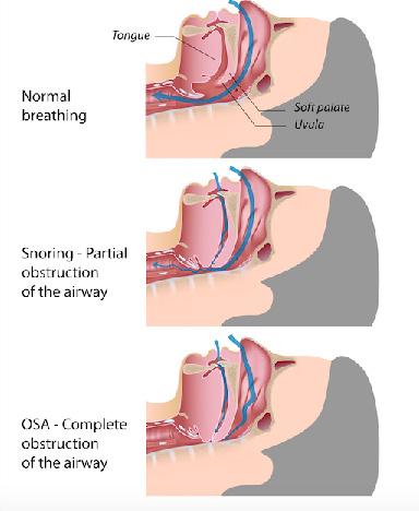 Snoring and Your Sleep: The Connection with Your Health Snoring occurs when air is not able to move through the throat efficiently to the lungs.