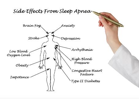 It occurs when the airway becomes blocked. Central sleep apnea arises when signals from the brain normally telling you to breathe are absent.