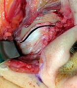 Expose temporalis fascia along whole length of incision