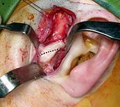 Sharply dissect off lateral pterygoid muscle attachment and remove condyle 6.