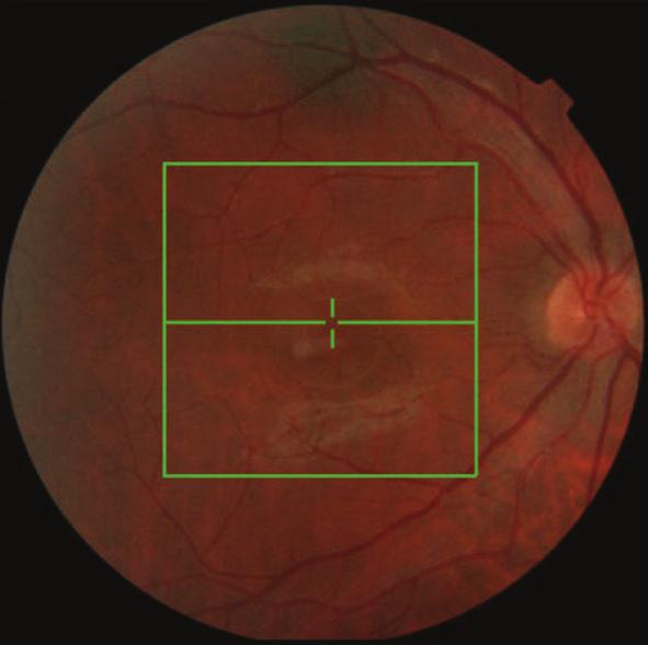 2 Case Reports in Ophthalmological Medicine (a) (b) Figure 1: Retinography showing mild hyperemia of both optic discs.