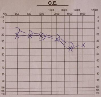 Case Reports in Ophthalmological Medicine 3 Right Left (a) (b) (c) (d) (e) Figure 3: Evolution of right and left audiograms. There is complete right hearing loss from the beginning.