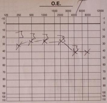 (d) and (e) show recovering of left hearing after treatment.