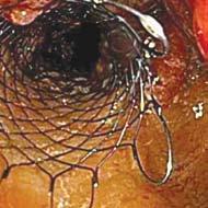 The stent was deployed under both fluoroscopic and endoscopic guidance. The stent was carried to the rectal vault to avoid the anus. Immediate relief of obstruction was noted.