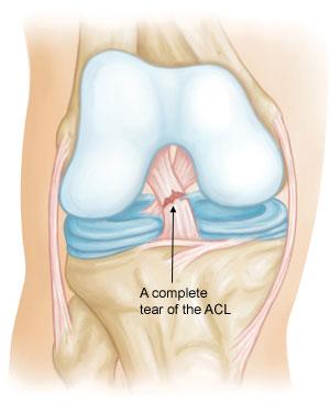 Description About half of all injuries to the anterior cruciate ligament occur along with damage to other structures in the knee, such as articular cartilage, meniscus, or other ligaments.