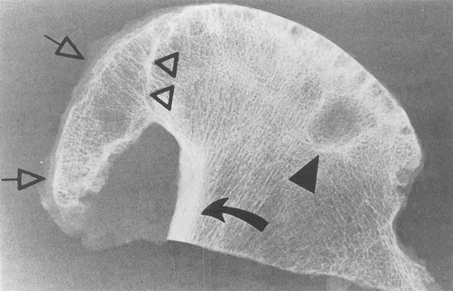 Figure 3. Tilt deformity in osteoarthritis.