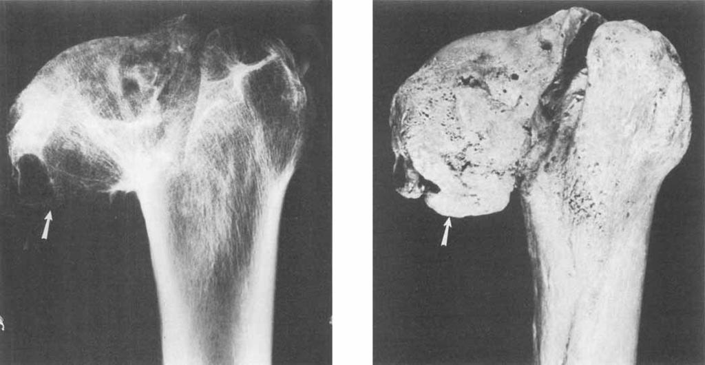 buttressing or cortical thickening of the medial portion of the femoral neck (curved arrow). Subchondral cysts (closed arrowhead) are seen. Figure 4.