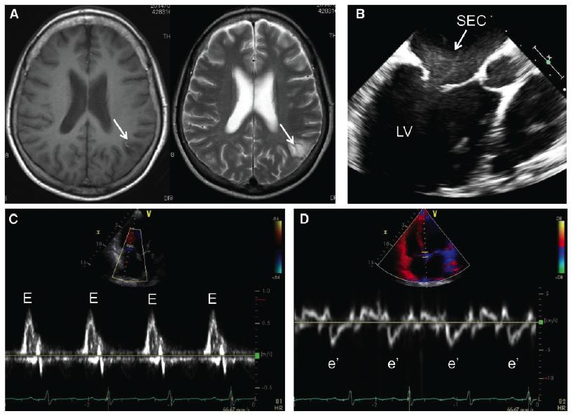 SEC, LAA emptying veloc, complex arch plaques Brain