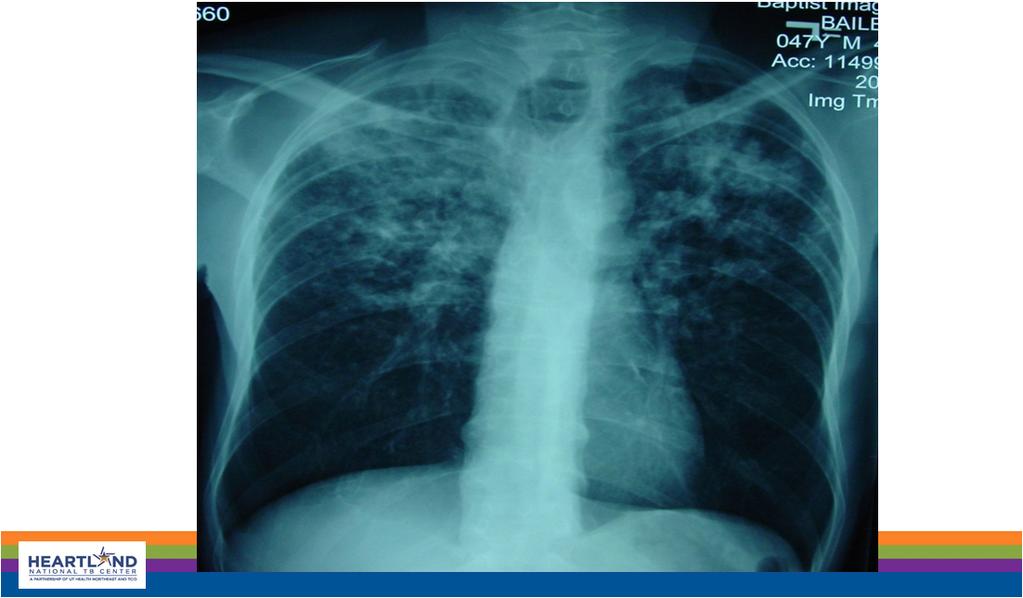 Reactivation Tuberculosis Standard Components of TB Evaluation Patient History Symptoms History, co morbidities, demographics, family history Hospital Discharge Information Physical examination