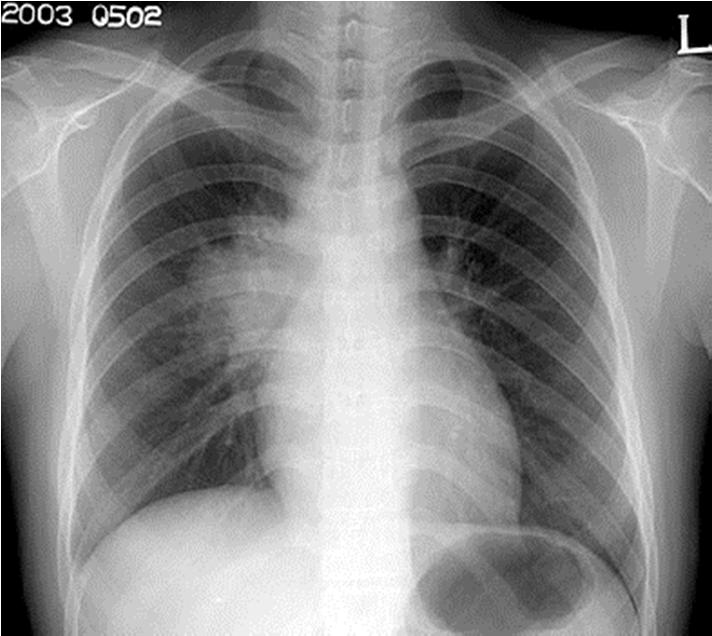 Primary Tuberculosis Most are asymptomatic; fever and nonproductive cough may occur Opacities are in middle