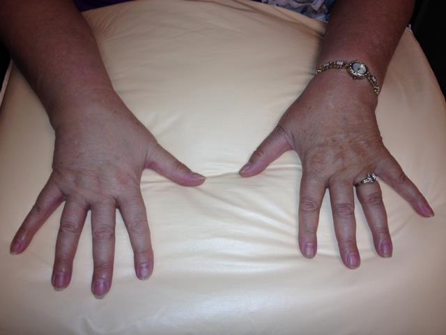 Lymphedema Lymphedema Swelling due to accumulation of protein and fluid