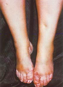 garments without first reducing edema Don t treat edema until it is