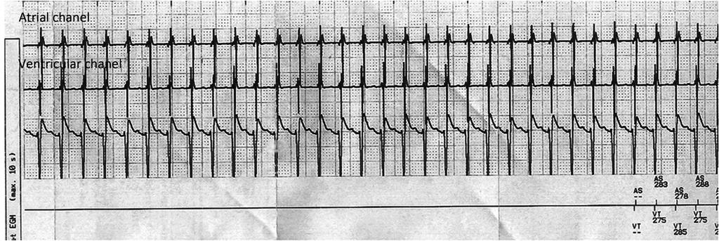 8.- A 48 year-old male patient with a dual chamber ICD visits the outpatient clinic complaining of an episode of regular tachycardia lasting for a few minutes which was associated with dizziness.