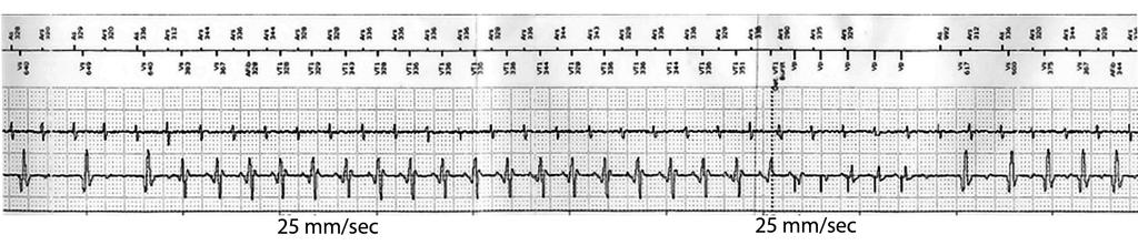 9.- In the following tracing the upper line shows atrial and ventricular marker annotations, the middle line shows atrial bipolar electrograms and the lower line shows ventricular bipolar