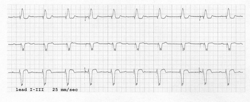 15.- What does the present ECG show? a.- Normal DDDR pacing mode b.