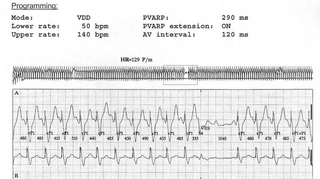 16.- The figure shows a detail of a Holter ECG from a patient with a VDD pacemaker. The following can be diagnosed from the ECG: a.