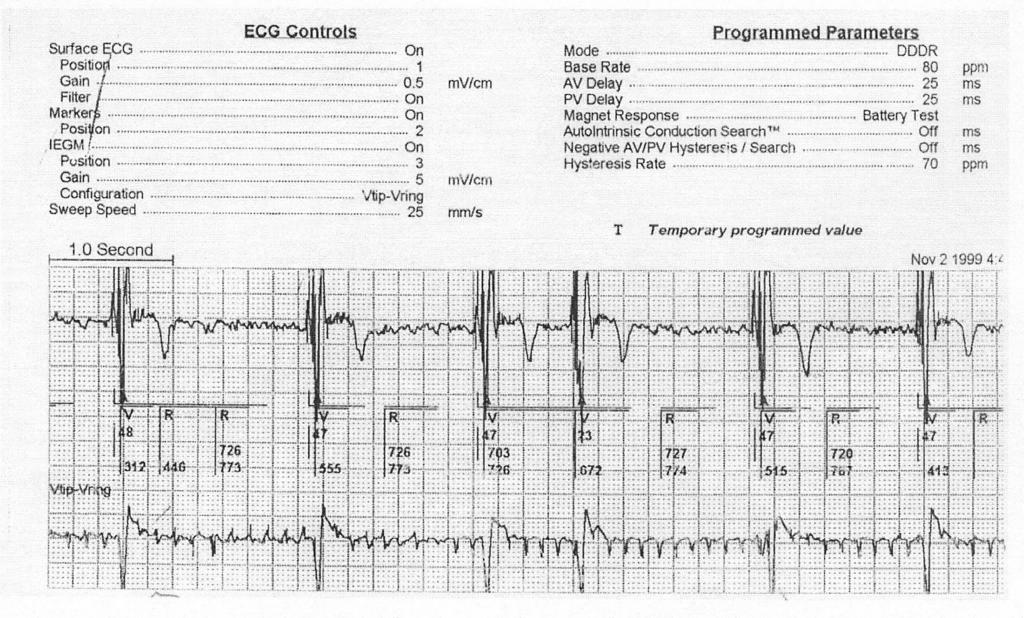 18.- A 63-year-old male patient with dilated cardiomyopathy and permanent atrial fibrillation received a dual-chamber pacemaker with the atrial channel connected to the RV lead and the ventricular