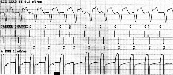 3.- The figure demonstrates a.- Magnet mode b.- Loss of atrial capture c.