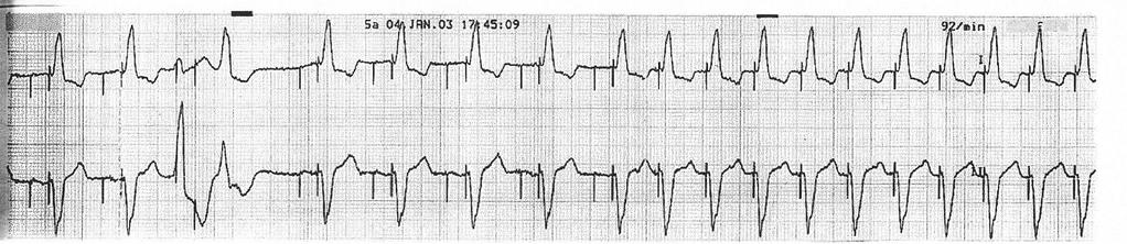 5.- The patient has a DDD-R pacemaker and complains of palpitations (see figure). What parameters do you adjust to resolve the situation? a.- Prolong the PVARP b.