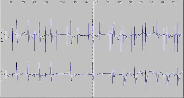 6.- A 69-year-old man had a DDDR pacemaker implanted for bradycardia-tachycardia syndrome. Why are some paced P waves not followed by a paced or spontaneous QRS complex in the tracing? a.- No output phenomenon b.