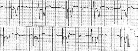 7.- A 54-year-old patient has had a DDD pacemaker implanted 24 hours earlier. The pacemaker was temporarily programmed to 30 bpm to obtain the following ECG.