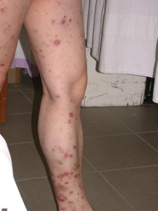 Cutaneous tuberculosis in Hong Kong Of the 16 cases of true CTB, seven defaulted, one refused treatment, and eight were available for follow-up.