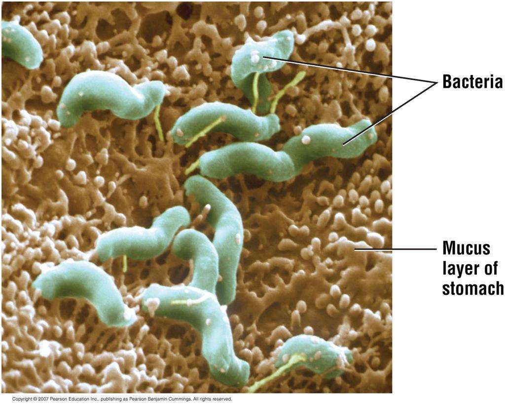 What causes gastric ulcers? The bacteria Helicobacter pylori H.