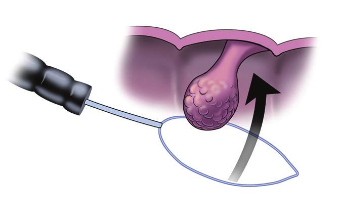 About the procedure What if colonoscopy shows an abnormality? If your surgeon sees an area that needs more detailed evaluation, a biopsy may be obtained and submitted to a laboratory for analysis.