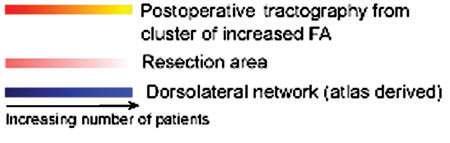 resection (R and L TLE) Increased FA in areas corresponding to