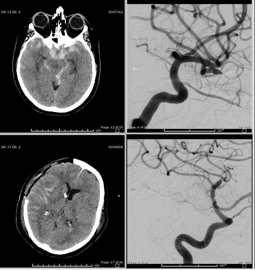 Clipping of aneurysm