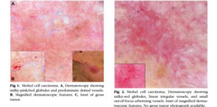 Merkel Cell Carcinoma Clinical and dermoscopic