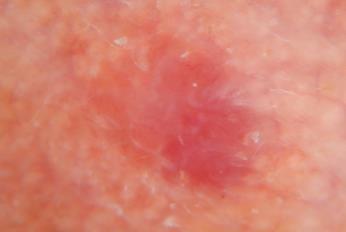 along with a nearby actinic keratosis (upper