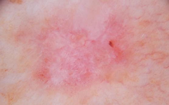 invasive melanomas, may be seen in
