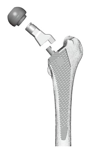 Be sure the axial and rotational stability of the final broach such that a press-fit fixation of the implant will be