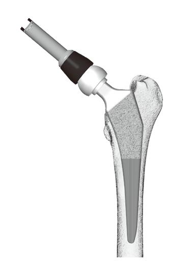Note: If the stem impactor impinges with greater trochanter, any impaction may lead to bone fracture.