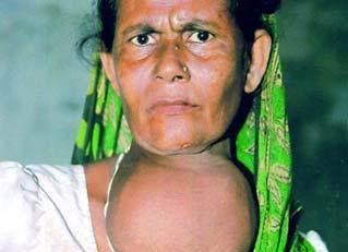 Goiter Goiter is a swelling of the thyroid gland caused by insufficient levels of iodine in an individuals diet.