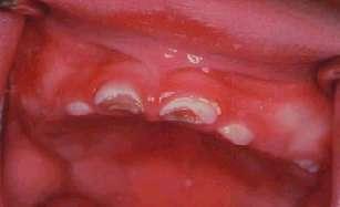 TOOTH DECA Y BACTERI A Decay Can with Begin