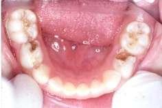 usually affects: First the upper incisors