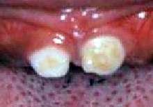 TOOTH DECA Y BACTERI A Developmental Defects FOOD More tooth defects in Premature infants Lower income