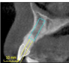 proximity to neurovascular canals, neighboring teeth or spaces such as lingual concavities and the maxillary sinus. 2.