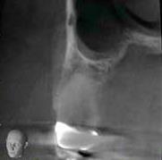 of intraosseous vessel in the Buccal-lateral wall of the maxillary sinus. H) I) J) 8. The MIC is rarely visible on conventional radiographs.